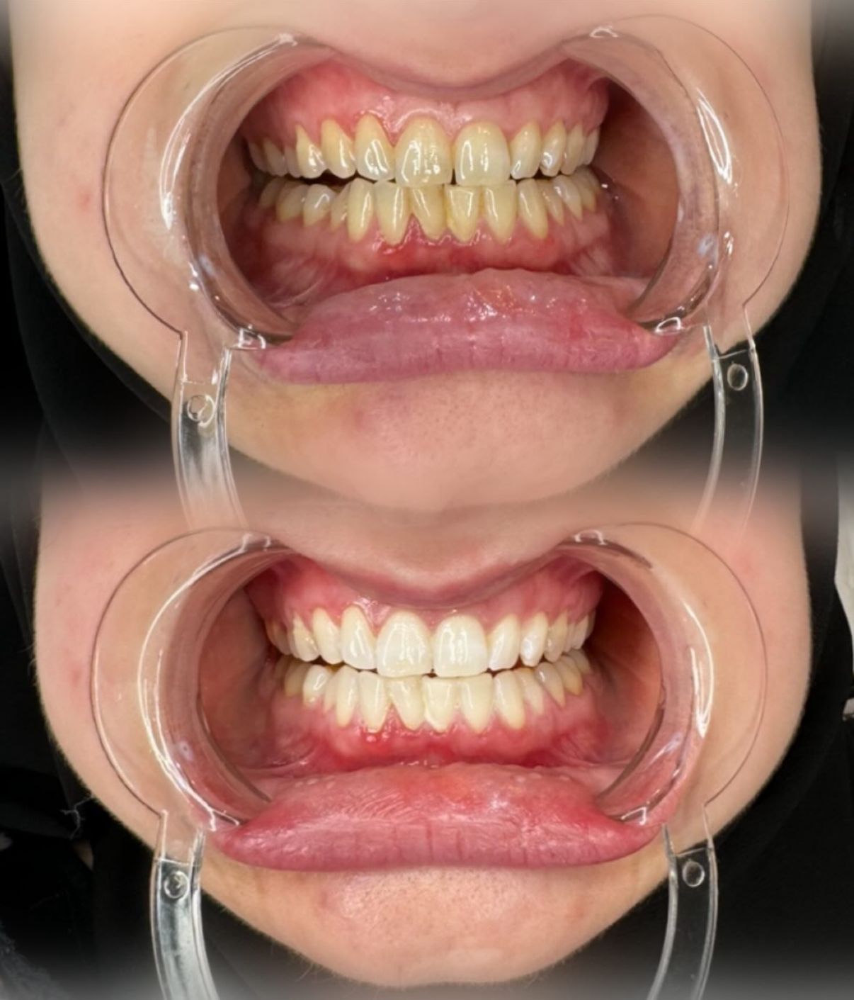 Professional Teeth Whitening studio work 1