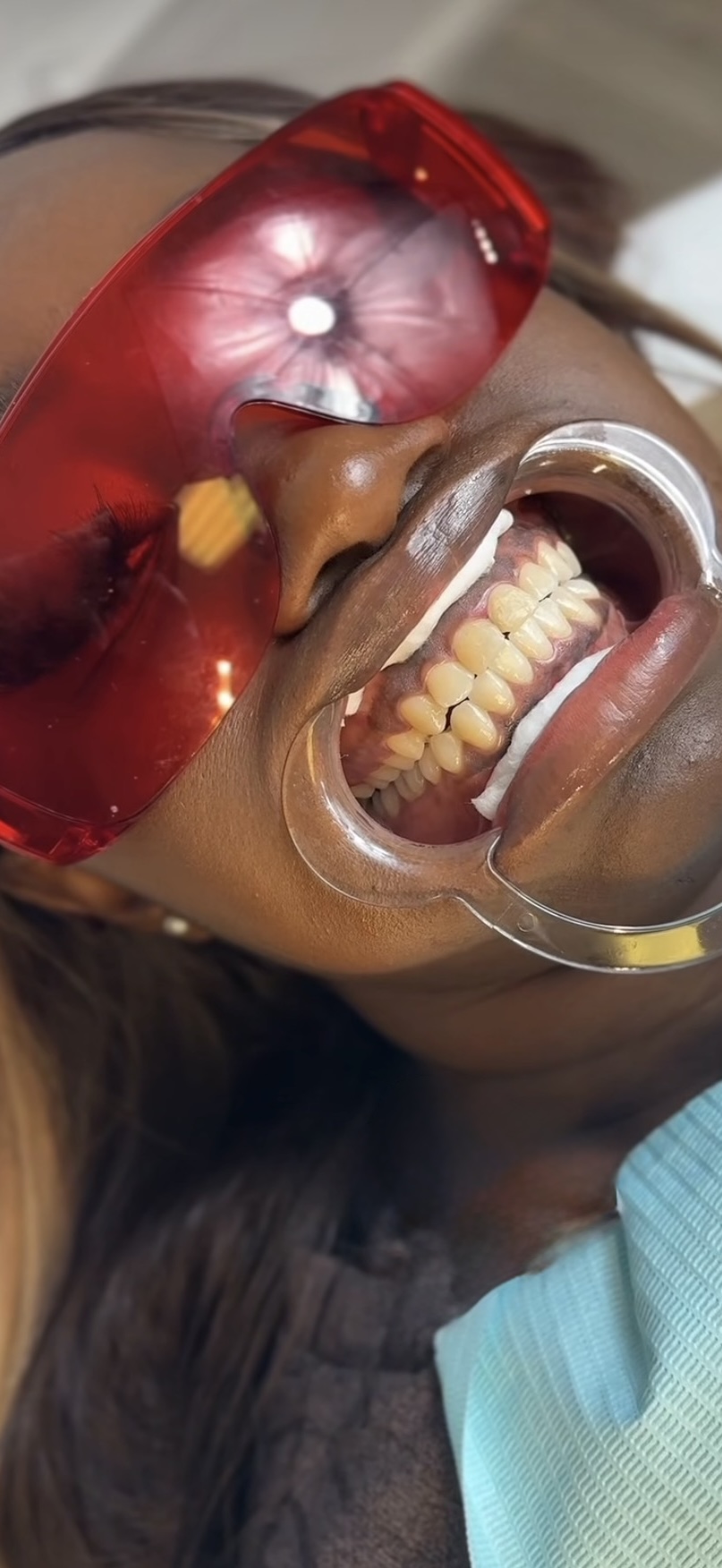 Professional Teeth Whitening studio work 2