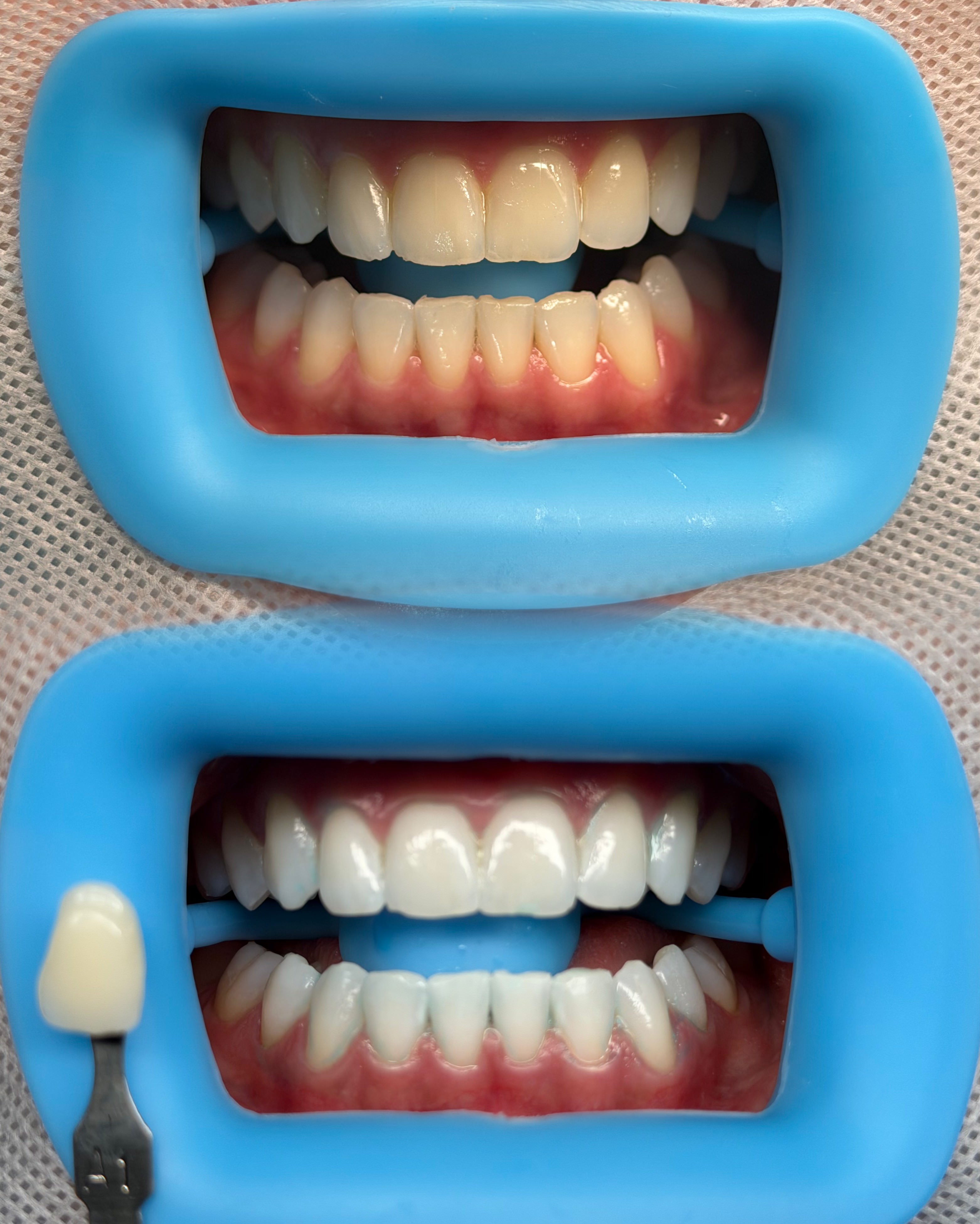 Professional Teeth Whitening studio work 4