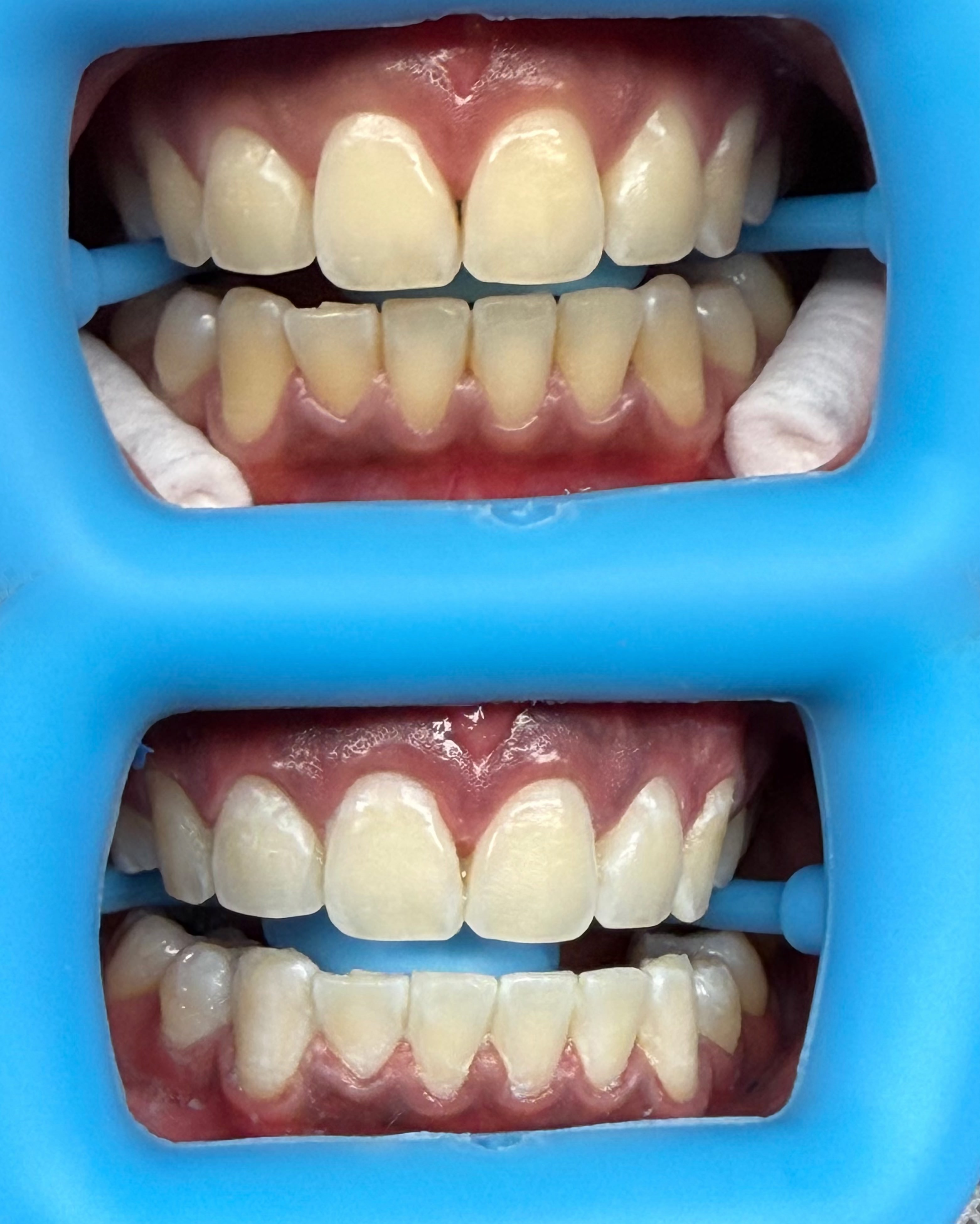 Professional Teeth Whitening studio work 5